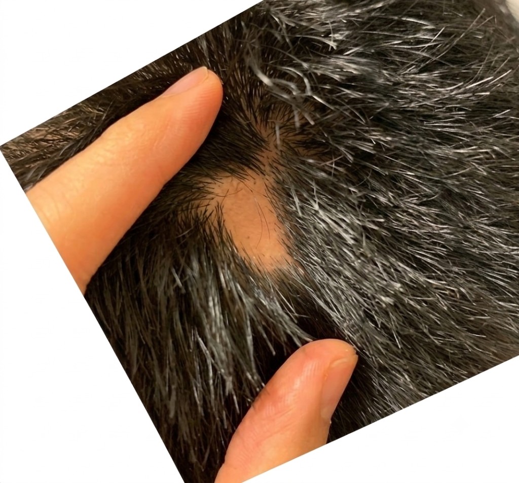 Scalp before alopecia treatment showing a bald patch