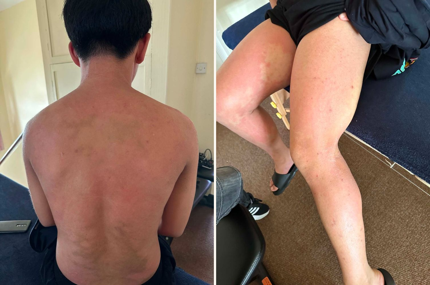 Back and legs before eczema treatment showing widespread redness and inflammation
